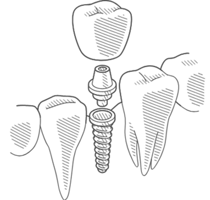 icon demonstrating dental implant